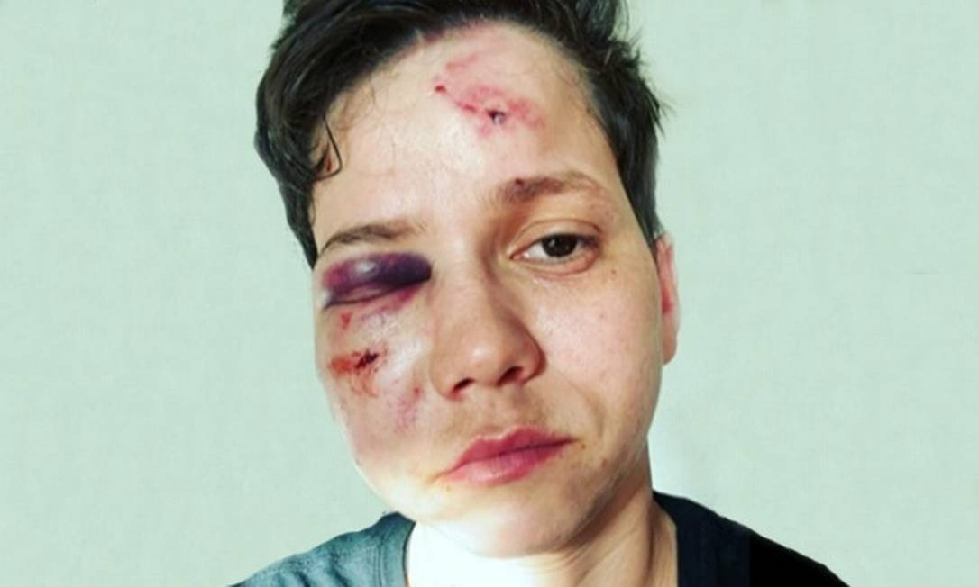 Youtuber Gay e apoiadora de Bolsonaro  Karol Eller fica desfigurada após ataque de esquerdistas ou homofóbicos